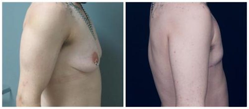 FTM Mastectomy Before & After Gallery - Patient 262507 - Image 3