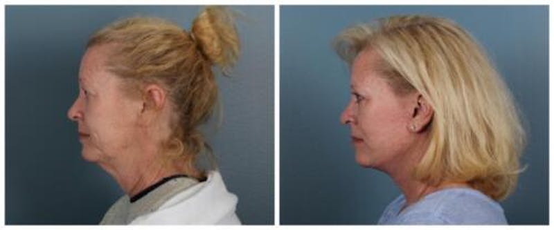 Face and Neck Lift Before & After Gallery - Patient 329341 - Image 5