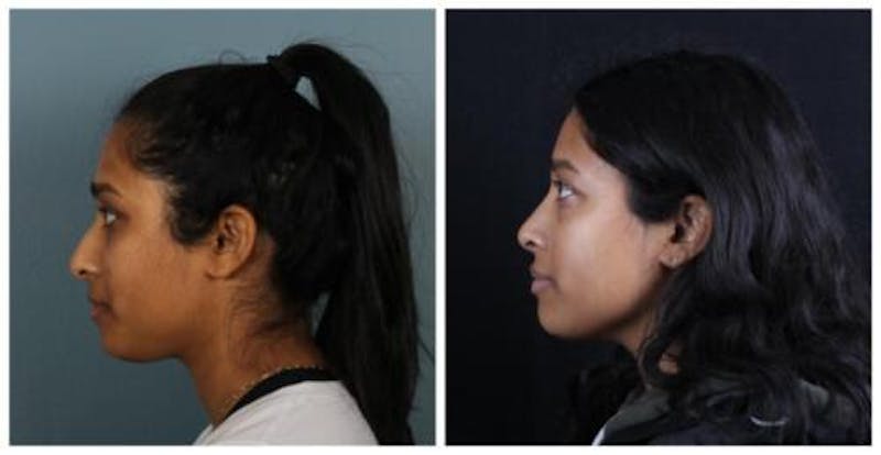 Rhinoplasty Before & After Gallery - Patient 165316 - Image 3