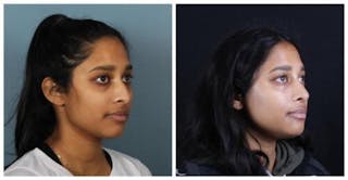 Rhinoplasty Before & After Gallery - Patient 165316 - Image 4