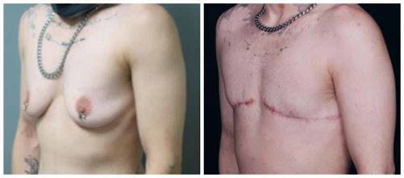 FTM Mastectomy Before & After Gallery - Patient 262507 - Image 5