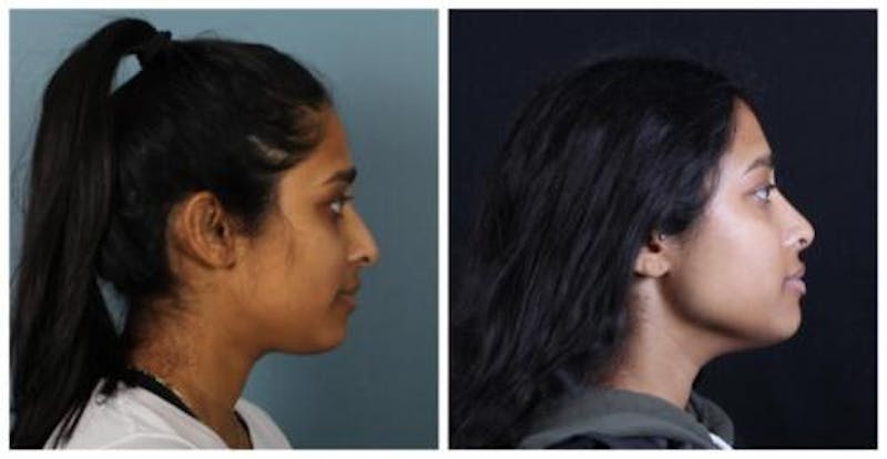 Rhinoplasty Before & After Gallery - Patient 165316 - Image 5