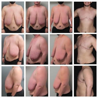 FTM Mastectomy Before & After Gallery - Patient 351818 - Image 1