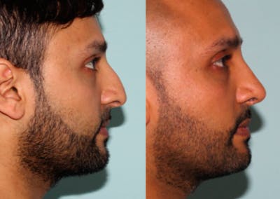 Rhinoplasty Before & After Gallery - Patient 429376 - Image 1