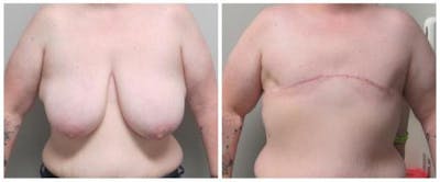 FTM Mastectomy Before & After Gallery - Patient 305486 - Image 1