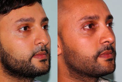 Rhinoplasty Before & After Gallery - Patient 429376 - Image 2