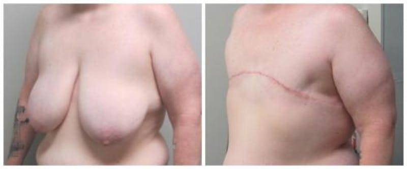 FTM Mastectomy Before & After Gallery - Patient 305486 - Image 2