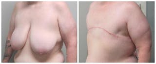 FTM Mastectomy Before & After Gallery - Patient 305486 - Image 2