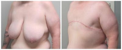 FTM Mastectomy Before & After Gallery - Patient 305486 - Image 2