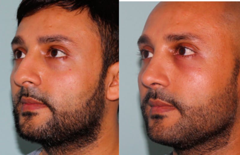 Rhinoplasty Before & After Gallery - Patient 429376 - Image 3