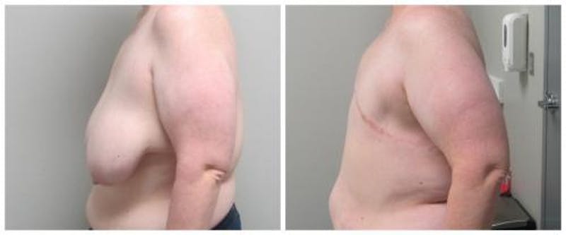 FTM Mastectomy Before & After Gallery - Patient 305486 - Image 3