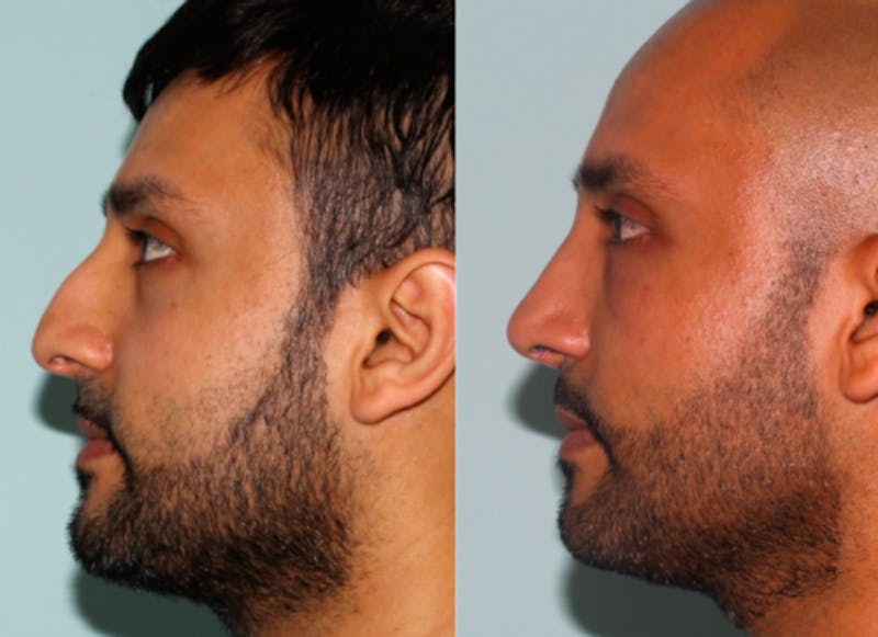 Rhinoplasty Before & After Gallery - Patient 429376 - Image 4