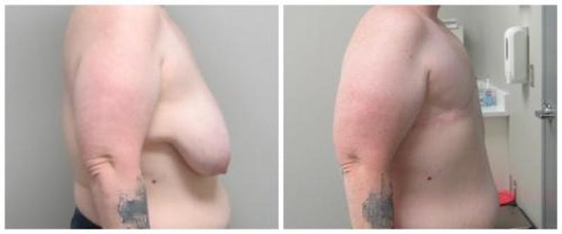 FTM Mastectomy Before & After Gallery - Patient 305486 - Image 4