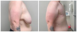 FTM Mastectomy Before & After Gallery - Patient 305486 - Image 4