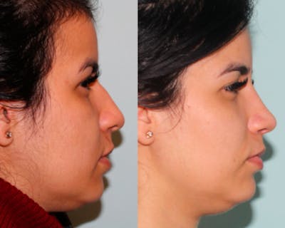 Rhinoplasty Before & After Gallery - Patient 289516 - Image 1