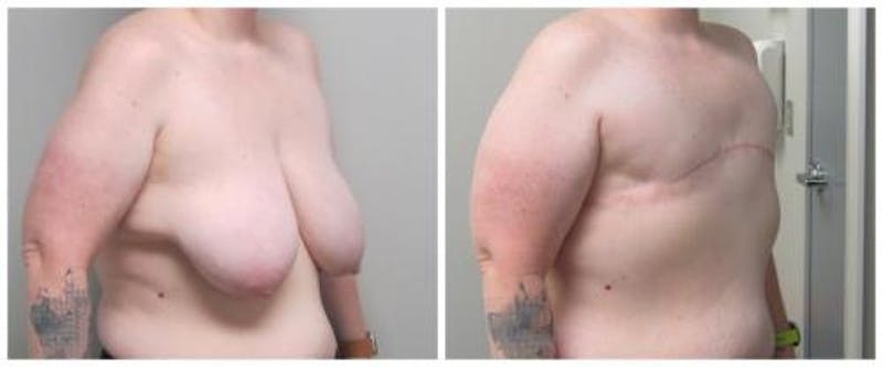 FTM Mastectomy Before & After Gallery - Patient 305486 - Image 5