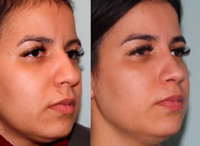 Rhinoplasty Before & After Gallery - Patient 289516 - Image 2