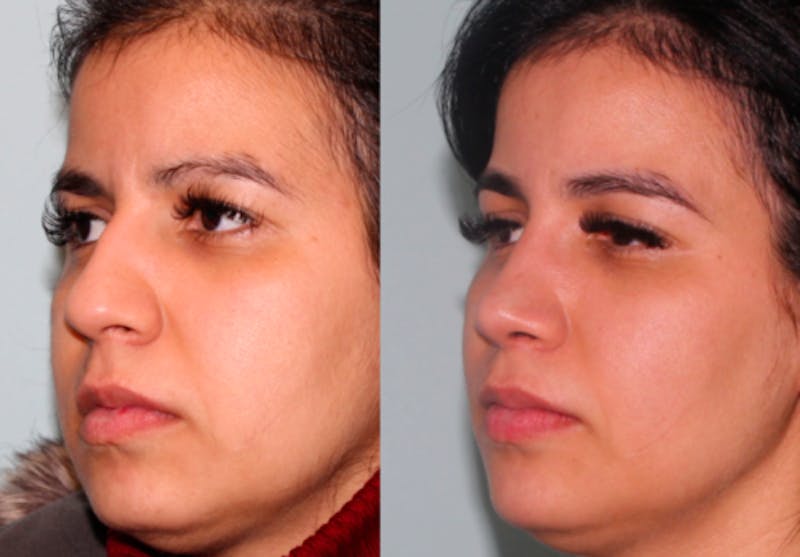 Rhinoplasty Before & After Gallery - Patient 289516 - Image 3