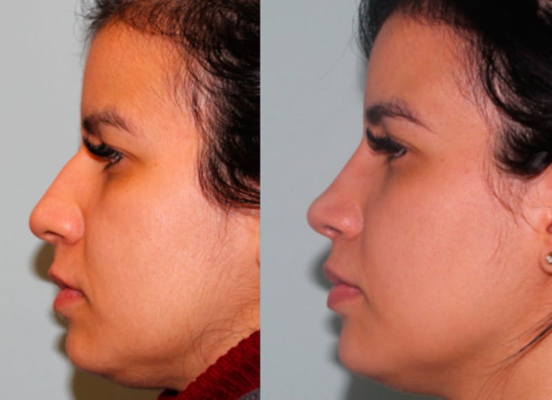 Rhinoplasty Before & After Gallery - Patient 289516 - Image 4