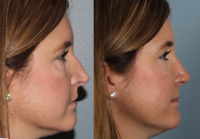 Rhinoplasty Before & After Gallery - Patient 102214 - Image 1