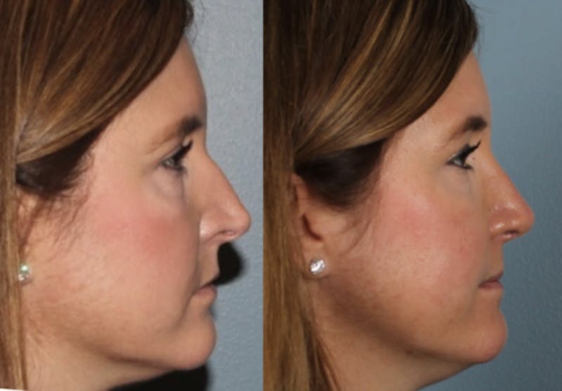 Rhinoplasty Before & After Gallery - Patient 102214 - Image 1