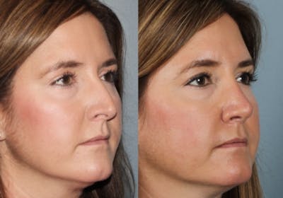Rhinoplasty Before & After Gallery - Patient 102214 - Image 2