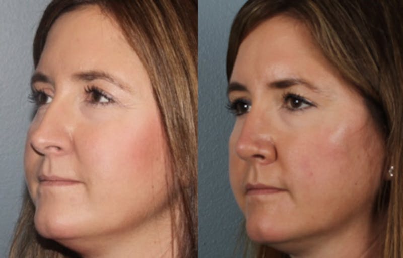 Rhinoplasty Before & After Gallery - Patient 102214 - Image 3