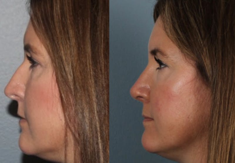 Rhinoplasty Before & After Gallery - Patient 102214 - Image 4