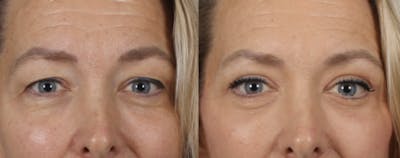 Rhinoplasty Before & After Gallery - Patient 360608 - Image 1
