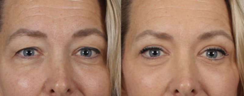 Rhinoplasty Before & After Gallery - Patient 360608 - Image 1