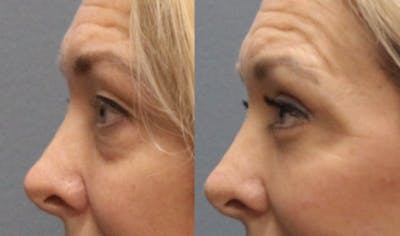 Rhinoplasty Before & After Gallery - Patient 360608 - Image 2