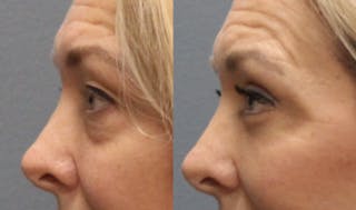 Rhinoplasty Before & After Gallery - Patient 360608 - Image 2