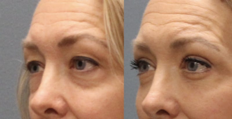 Rhinoplasty Before & After Gallery - Patient 360608 - Image 3