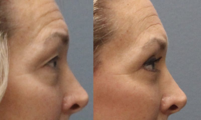 Rhinoplasty Before & After Gallery - Patient 360608 - Image 5