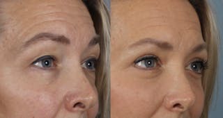 Rhinoplasty Before & After Gallery - Patient 360608 - Image 4