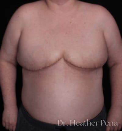 FTM Top Surgery Before & After Gallery - Patient 114708 - Image 2