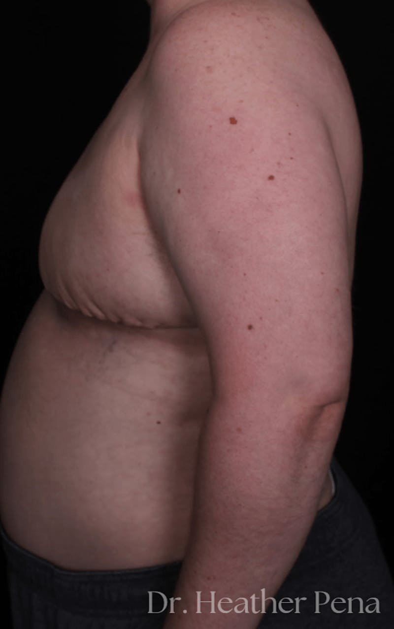 FTM Top Surgery Before & After Gallery - Patient 114708 - Image 4