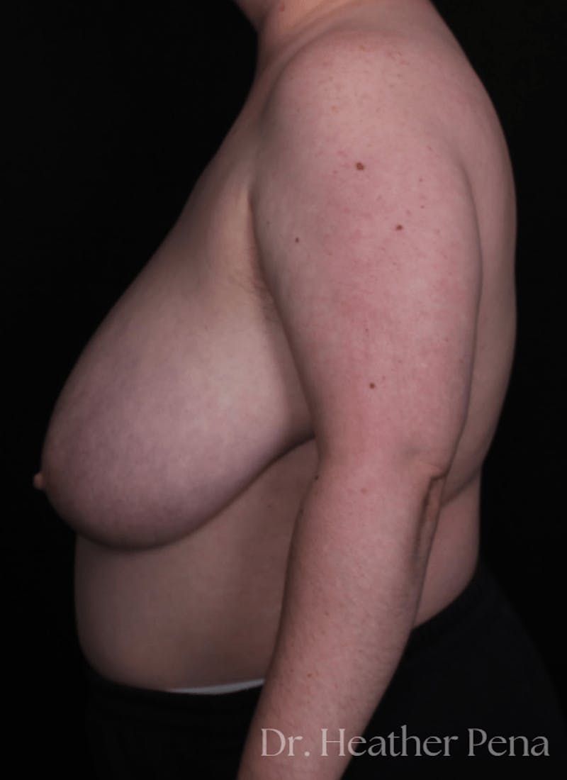 FTM Top Surgery Before & After Gallery - Patient 114708 - Image 3