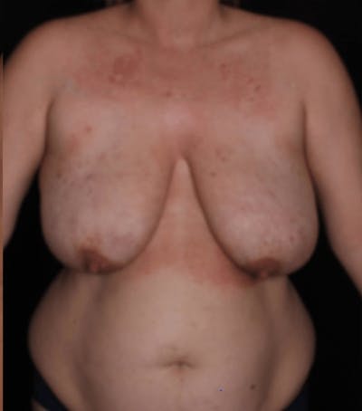 Breast Reduction Before & After Gallery - Patient 184844 - Image 1