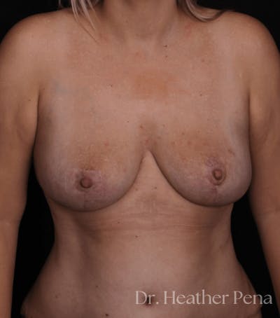 Breast Reduction Before & After Gallery - Patient 184844 - Image 2