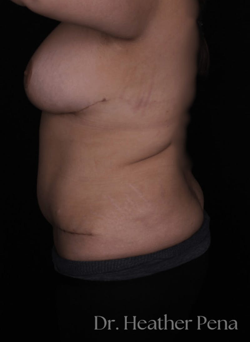 Breast Reduction Before & After Gallery - Patient 229625 - Image 4