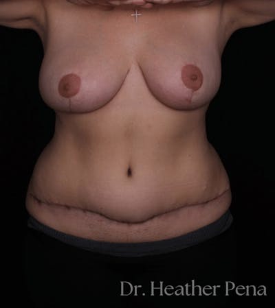 Breast Reduction Before & After Gallery - Patient 229625 - Image 2