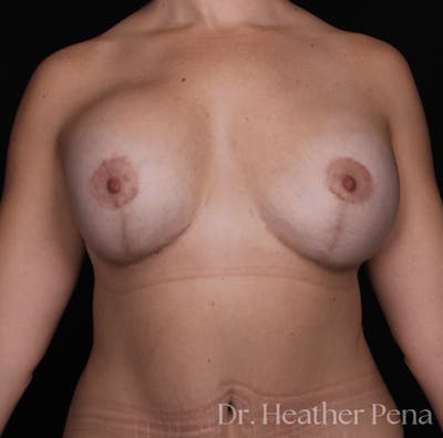Breast Augmentation Before & After Gallery - Patient 310195 - Image 2