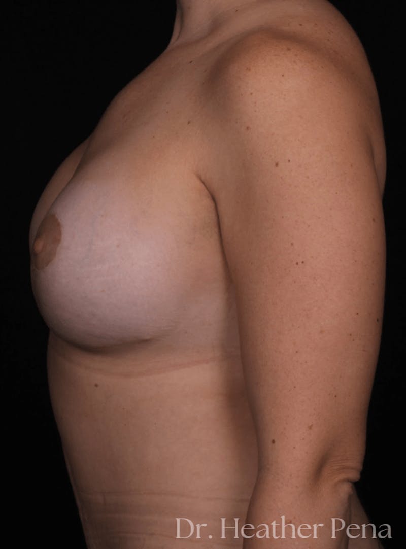 Breast Augmentation Before & After Gallery - Patient 310195 - Image 4
