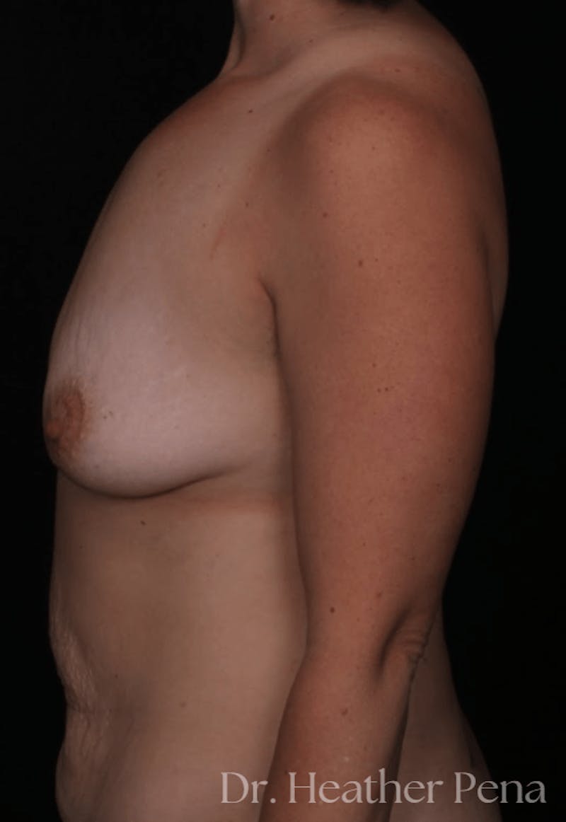 Breast Augmentation Before & After Gallery - Patient 310195 - Image 3