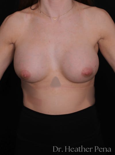 Breast Augmentation Before & After Gallery - Patient 126209 - Image 2