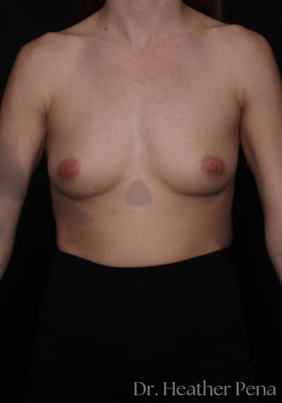Breast Augmentation Before & After Gallery - Patient 126209 - Image 1