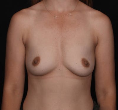 Breast Augmentation Before & After Gallery - Patient 256653 - Image 1