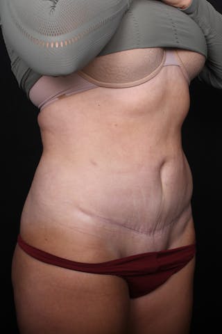 Abdominoplasty Before & After Gallery - Patient 255400 - Image 4