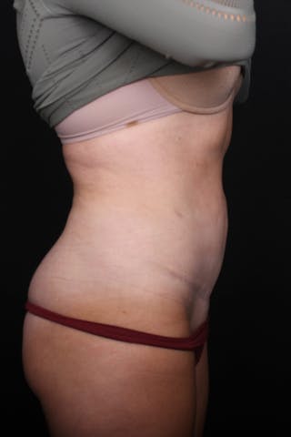 Abdominoplasty Before & After Gallery - Patient 255400 - Image 6